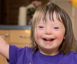 How to diagnose down syndrome symptoms